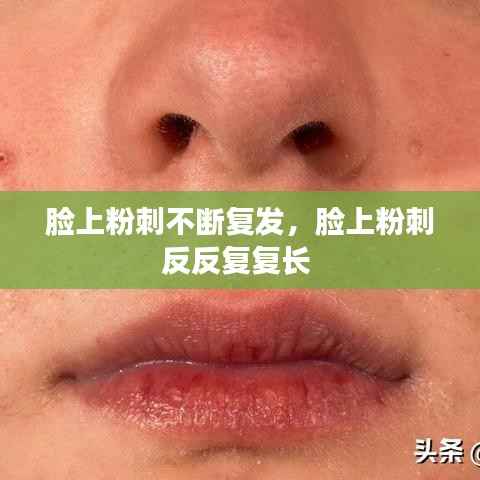 脸上粉刺不断复发,脸上粉刺反反复复长
