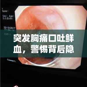 突发胸痛口吐鲜血，警惕背后隐藏的警示信号！